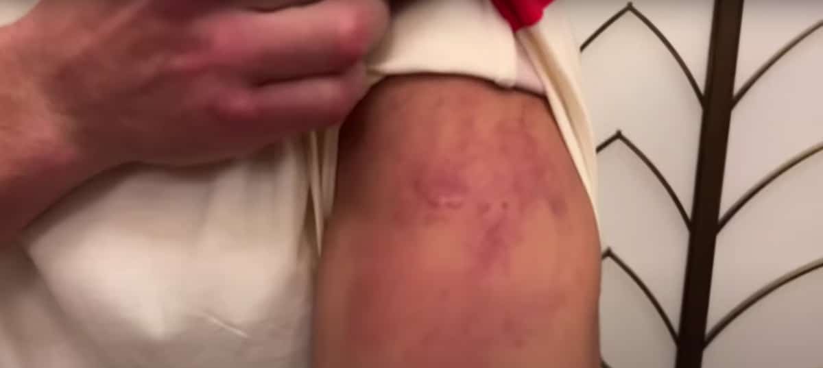 Image: Bivol's arm badly bruised from Canelo punches