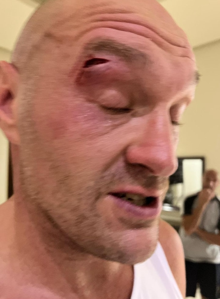 Image: Tyson Fury Injury Postpones Undisputed Title Fight against Oleksandr Usyk